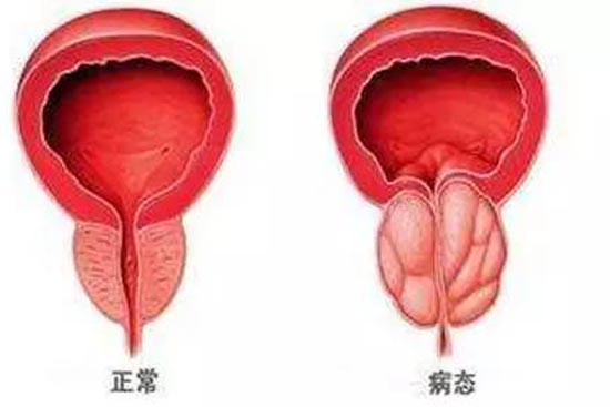 前列腺炎癥能否自愈，解析、理解與應對，前列腺炎癥能否自愈，解析、應對及理解指南