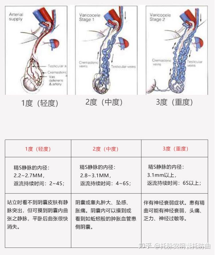 精索靜脈曲張三個程度圖詳解，精索靜脈曲張三個程度詳解圖解