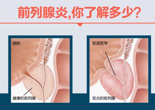 前列腺炎的治愈可能性，理解與探索，前列腺炎的治愈可能性，深入理解與探索