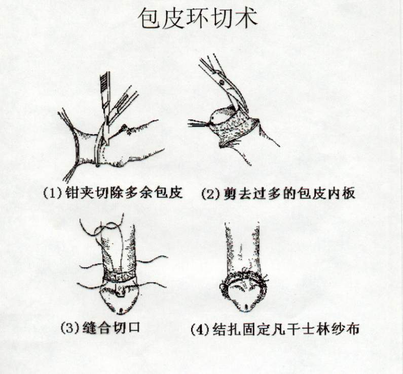 關(guān)于包皮手術(shù)后多久可以同房的問題解答，包皮手術(shù)后恢復(fù)與同房時(shí)間指南