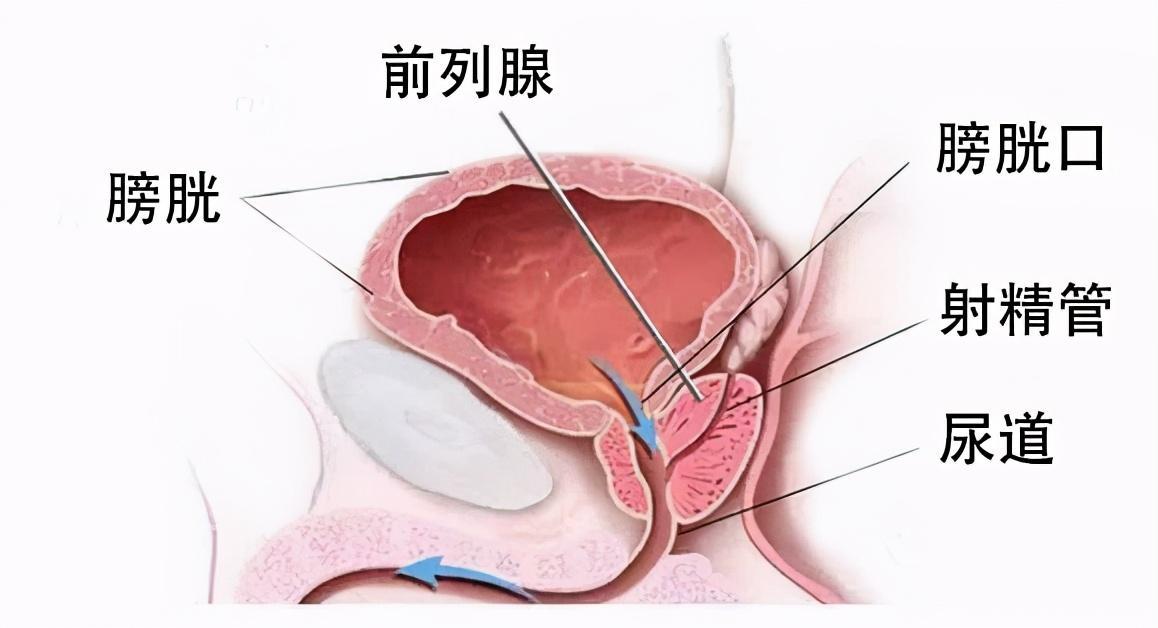 前列腺炎治療周期詳解，前列腺炎治療周期全面解析