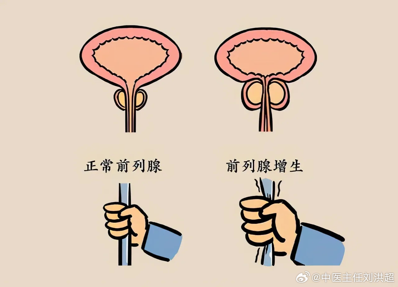 前列腺結(jié)石與性功能障礙，是否存在關(guān)聯(lián)？，前列腺結(jié)石與性功能障礙的關(guān)聯(lián)探討，是否存在潛在聯(lián)系？