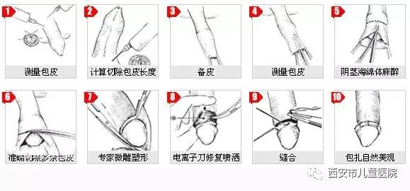 關(guān)于做包皮手術(shù)是否疼痛，一種全面的解讀與應(yīng)對(duì)建議，包皮手術(shù)疼痛解讀及應(yīng)對(duì)建議，全面解析與指導(dǎo)